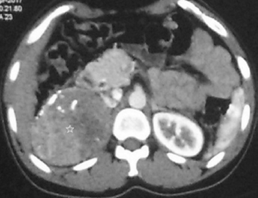 Contrast-enhanced computed tomography showing well-defined heterodense right adrenal lesion (star).